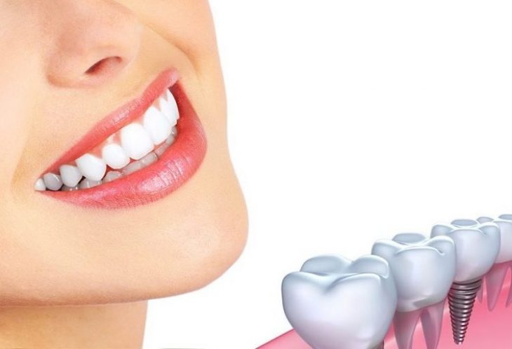 Dental Implants: A Detailed Analysis - My Health Blogs - Get Fit Online